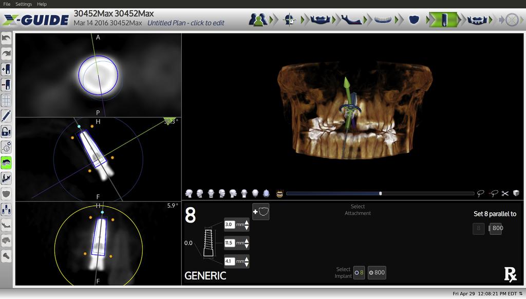 1384 IMPLANT PLACEMENT USING DYNAMIC NAVIGATION FIGURE 3. An example of a mesh used to determine accuracy.