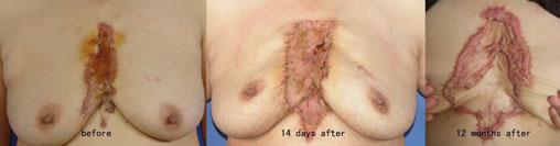 In cases of small keloids, the wound edge after keloid removal can be TABLE 2.