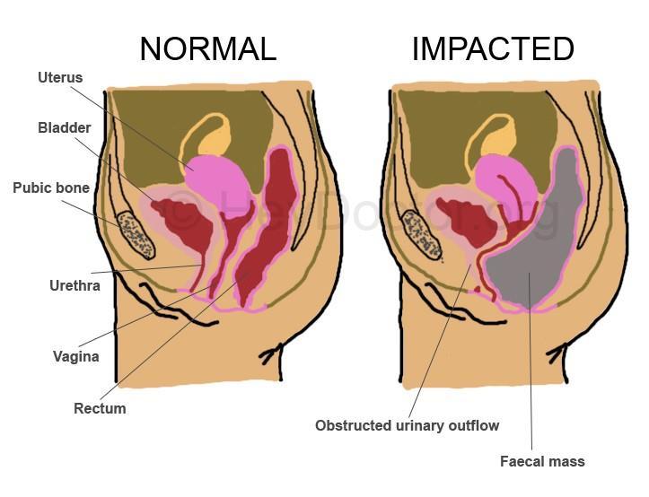 Stool Impaction Initially constipation can