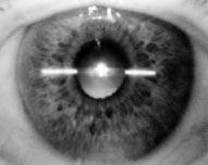 1234 Bechmann, Thiel, Roesen, et al with a history of former incisional surgery, corneal disease, diabetic retinopathy, injury, recent contact lens wear, or steroid use were excluded.