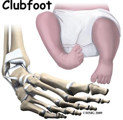 Introduction Clubfoot is a congenital condition that affects newborn infants. The medical term for clubfoot is Congenital Talipes Equinovarus.
