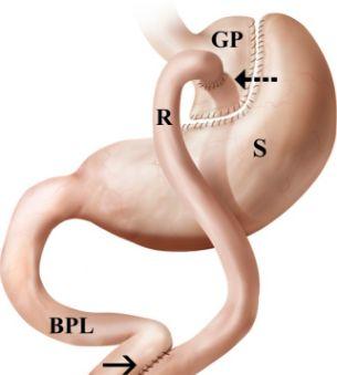 Anastomotic Leak and its Severity Anastomosis- A surgical connection between two structures ¹ The most commonly reported location for gastrointestinal leak after G.B.