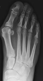 Bunion (Hallux valgus) A bony bump that forms on the joint at the base of the big toe due to the big toe