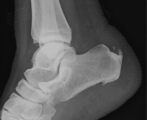 Calcified and swollen Achilles tendon Plantar calcaneal spur Posterior calcaneal spur Soft tissue