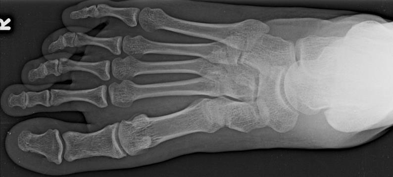 Radiographic Anatomy Fore foot Mid foot