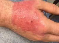 CECM dressing applied post debridement in the OR and covered with a non-adherent dressing and gauze wrap Case Study 4: Patient: 49 year-old male presented with cellulitis and a non-healing
