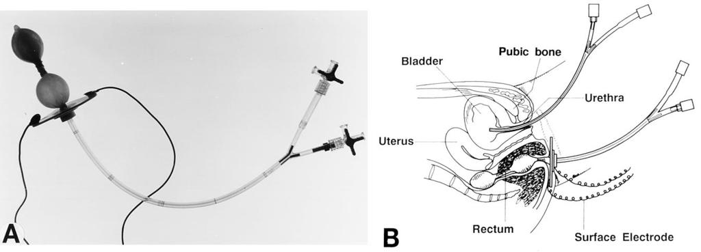 BIOFEEDBACK TRAINING FOR DETRUSOR OVERACTIVITY 1687 anatomical abnormalities of the urethra, such as posterior urethral valves or ring stricture of the bulbar urethra, were also excluded from study.