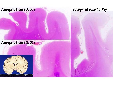 Table 2. Summary of clinical findings of the CNS (frontal lobes) Figure 3. Low-magnification microscopy images of the frontal lobe.