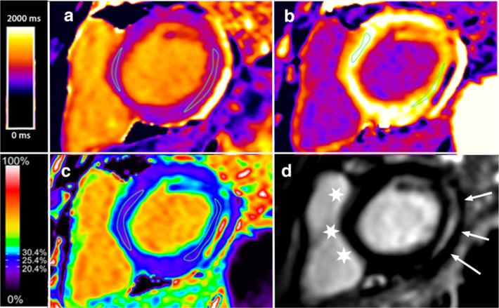 Olivieri et al. Journal of Cardiovascular Magnetic Resonance (2016) 18:72 Page 4 of 11 Fig. 2 Short axis view of the same boy with DMD depicted in Fig. 1 with lateral wall fibrosis using MOLLI.