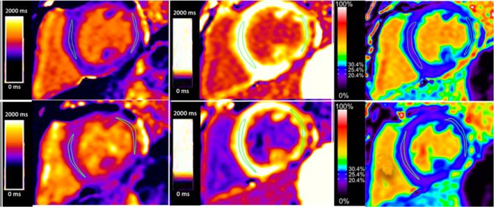 Olivieri et al. Journal of Cardiovascular Magnetic Resonance (2016) 18:72 Page 6 of 11 Fig. 3 Comparison of an identical short axis slice using MOLLI (top row) and SASHA (bottom row).