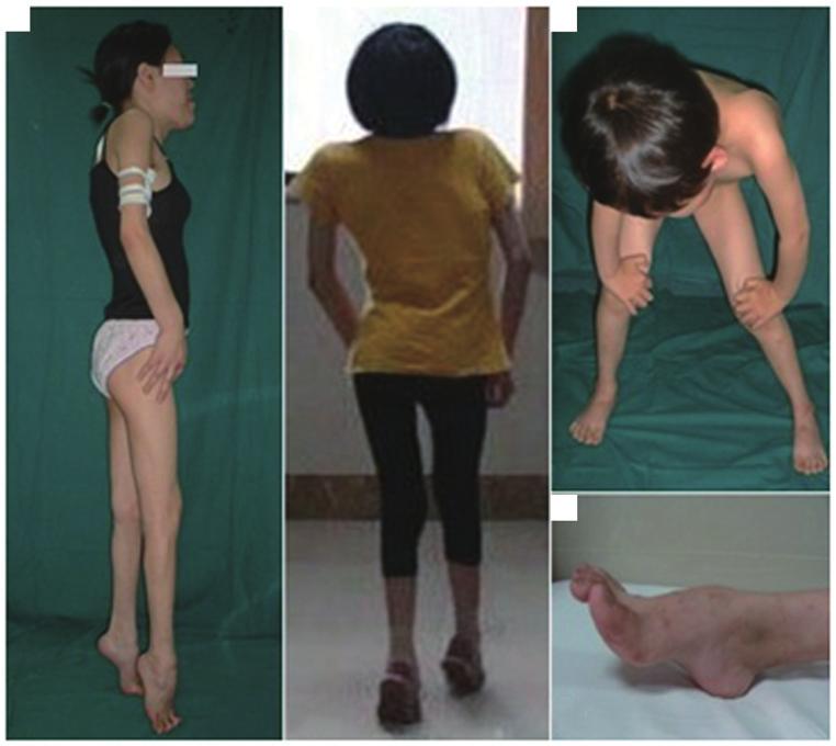 MOLECULAR MEDICINE REPORTS 12: 5065-5071, 2015 5067 A B C D Figure 1. Images of the three patients with Emery Dreifuss muscular dystrophy in the present study.