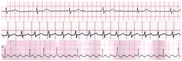 MOLECULAR MEDICINE REPORTS 12: 5065-5071, 2015 5069 A B C Figure 4. Electrocardiogram traces of patients 1, 2 and 3. (A) Patient 1 exhibited a complete atrioventricular block.