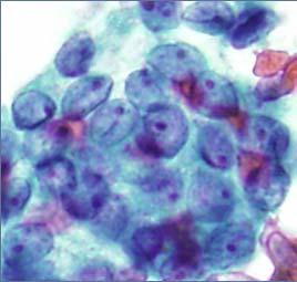Overall risk of malignancy low, 1 4% Guidelines recommend repeating an FNA If repeat FNA non
