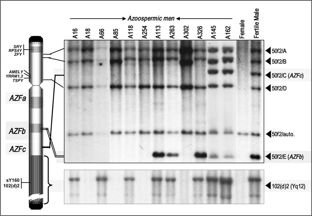 Thangaraj et al Y Chromosome Deletion in Azoospermic Men 593 Figure 4.