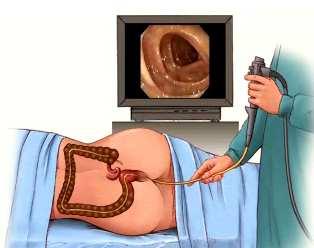 Indications for Endoscopy New onset constipation: Weight loss, macroscopic or microscopic blood, family h/o colon Ca, anemia, undiagnosed abdominal pain