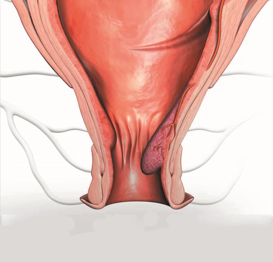Internal Haemorrhoids Stage 1: Little enlargement of