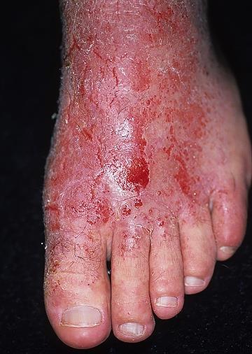 AD is a Chronic, Inflammatory Skin Disease, Characterized by Intractable