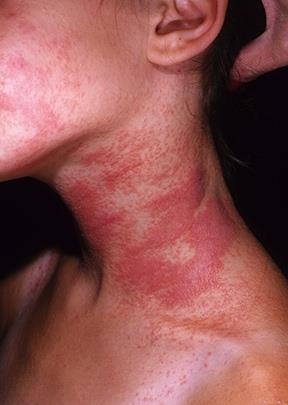 involving immune-mediated inflammation, skin-barrier defect, genetic factors