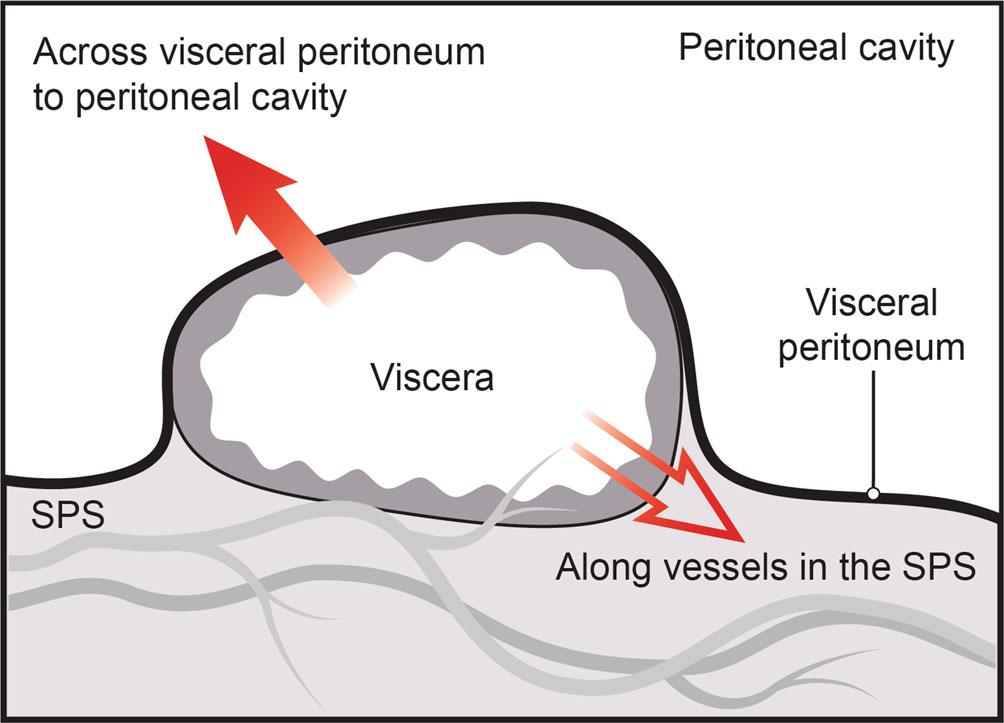 Disease can cross the visceral peritoneum (solid arrow) to enter and subsequently spread in the peritoneal cavity.