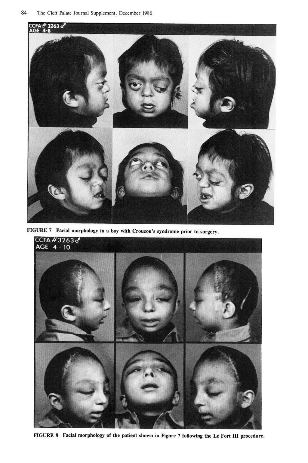 84 The Cleft Palate Journal Supplement, December 1986 Cccra# 3263 5 AGE 4-8 FIGURE 7 Facial morphology in a boy with