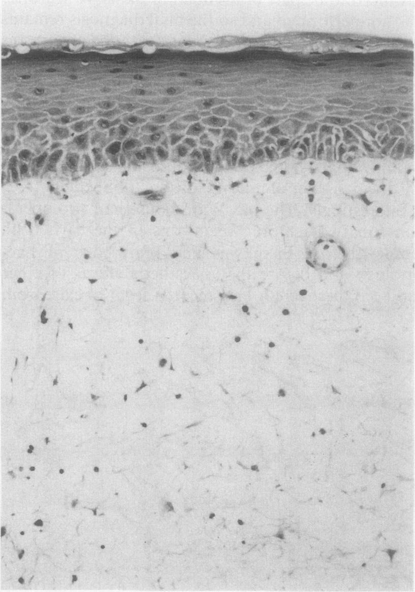 J Clin Pathol 1989;42:460-465 Aural polyps as predictors of underlying cholesteatoma C M MILROY,* R W T SLACK,t A R MAW,f J W B BRADFIELD* From the * University Department of Pathology and