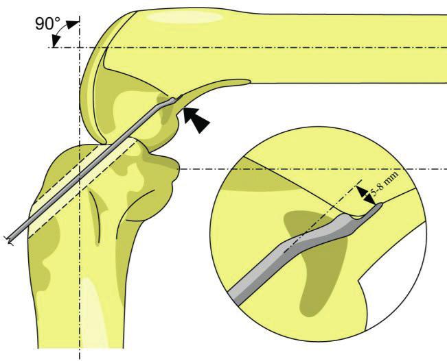 6. Aiming and drilling of the tibial tunnel using drilling wire Check the diameter of the patellar tendon graft, choose diameter of the drill accordingly and overdrill the drilling wire using the