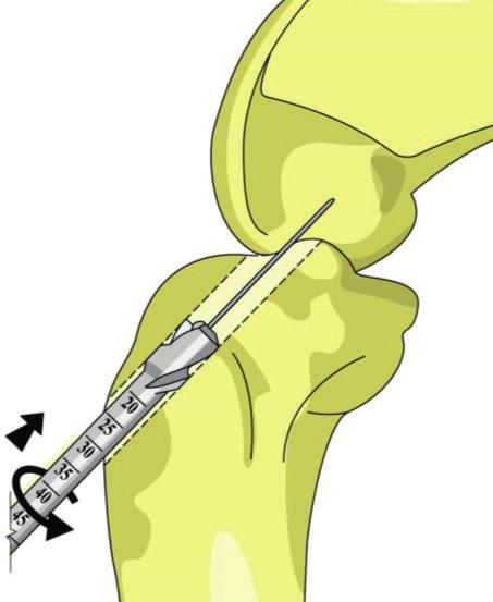 The aiming of the femoral tunnel a) Through the tibial tunnel (transtibial drilling) the knee is bent at 90 depending on the diameter of the selected drill for drilling of the tibial hole and on the
