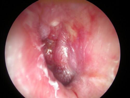 A 4 year old boy presents with right sided ear pain for 24 hours.