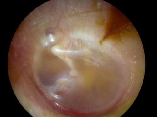 Otitis media with effusion is the presence of fluid in the