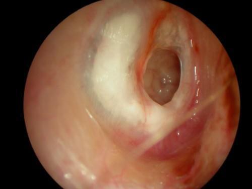 Chronic "dry" anterior tympanic membrane perforation, pain is due to water entering the middle ear.