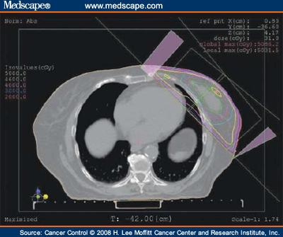 Conventional tangent radiation for breast cancer Heart is