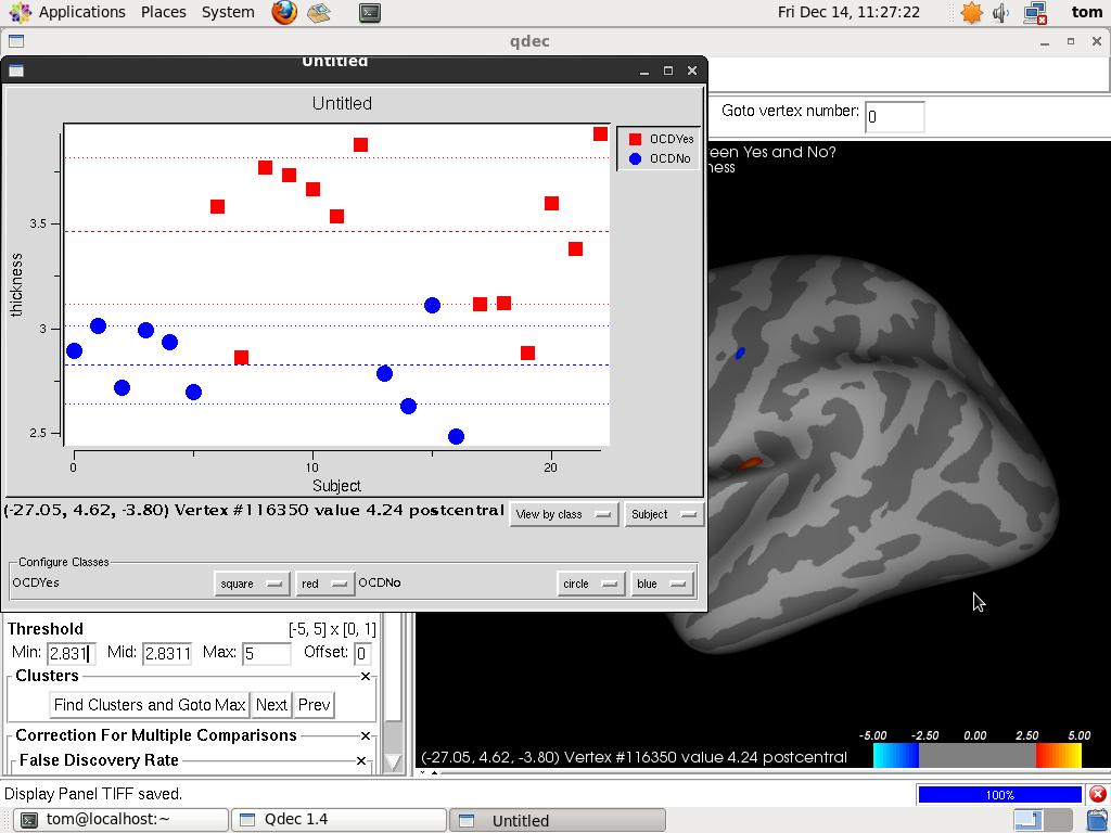 Figure 3.5. Significant difference between patients and controls at the postcentral gyrus in the left hemisphere (orange cluster). The blue cluster was rejected as it was too small (area < 50 mm 2 ).