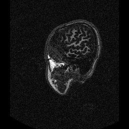 and some gray matter. In some cases a small amount of the white matter is not included either (fig 1.1).