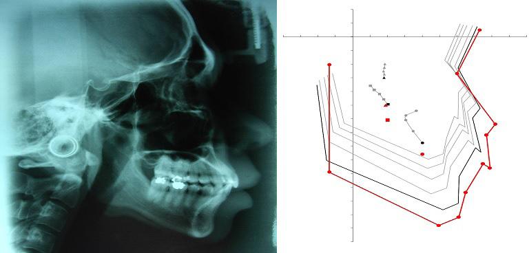 5 Figure 15:Lateral Cephalometric film after active treatment Figure 17: Superimposition after active treatment Discussion Treatment of posterior buccal crossbite case is a challenging scope of