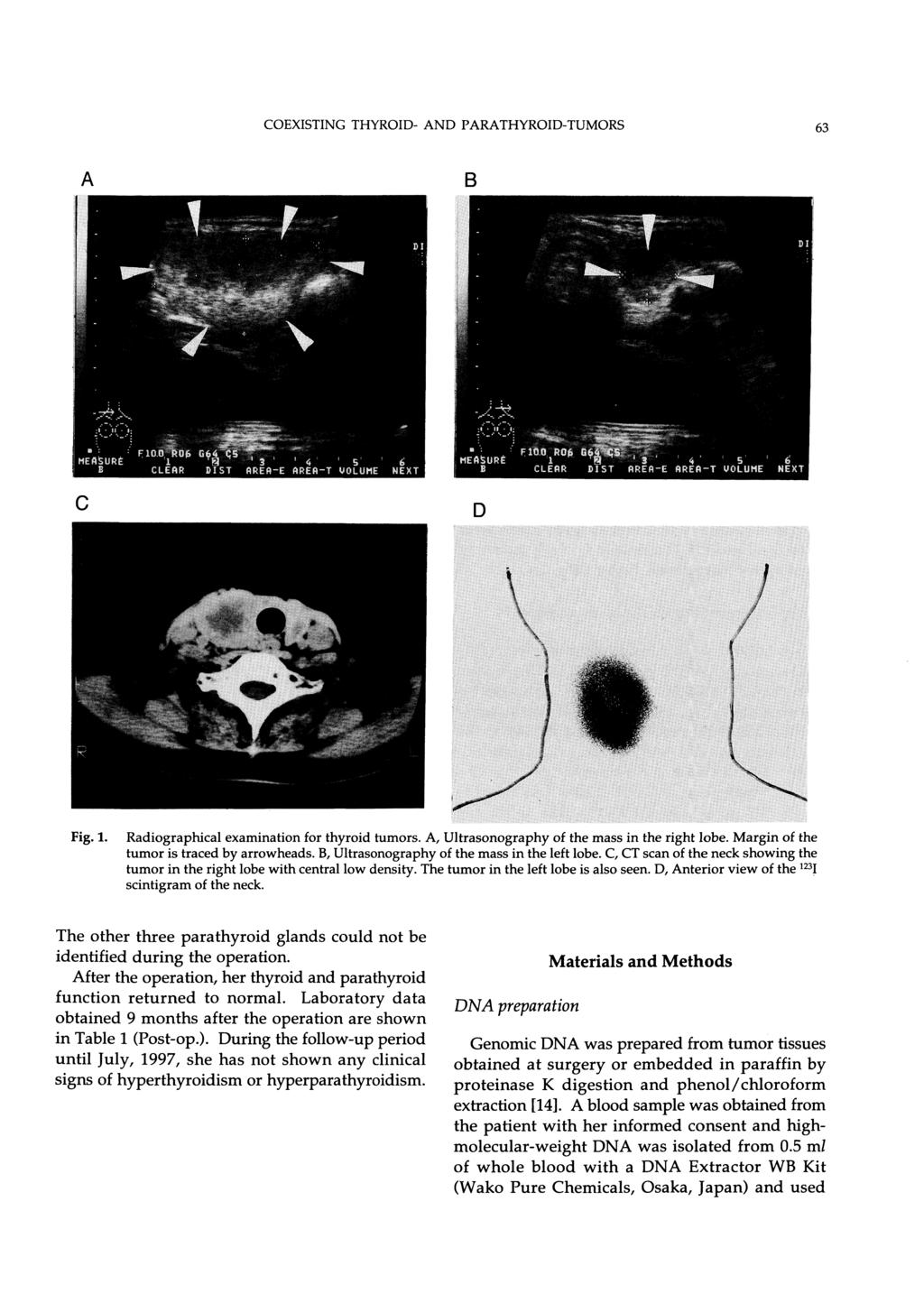 COEXISTING THYROID- AND PARATHYROID-TUMORS 63 Fig. 1. Radiographical examination for thyroid tumors. A, Ultrasonography of the mass in the right lobe. Margin of the tumor is traced by arrowheads.