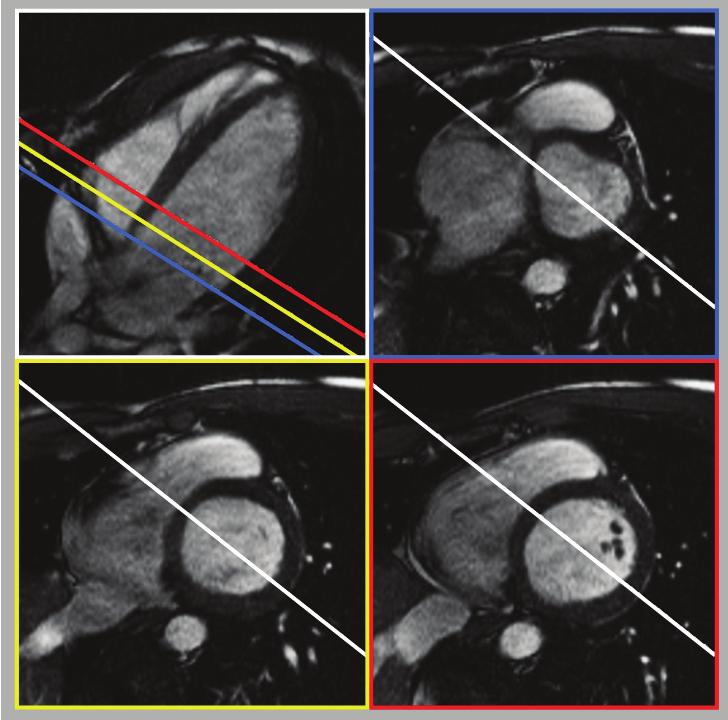 Quantification in cardiac MRI 21 Chapter 2 Figure 2-6. Four-chamber long-axis view and three basal level short-axis views acquired within the same examination (left: end-diastole, right: end-systole).