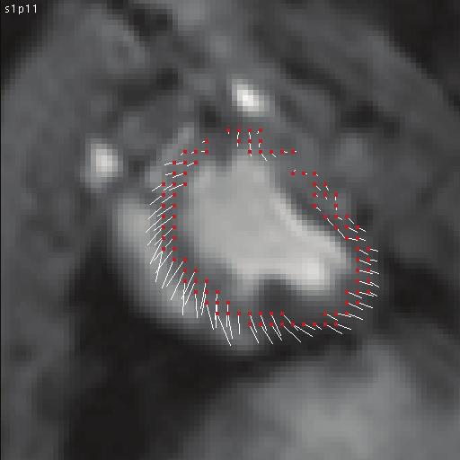 Chapter 2 Figure 2-9. Short-axis images obtained by phase-contrast cine MRI at early diastole. The images are obtained from a pig after acute myocardial infarction.