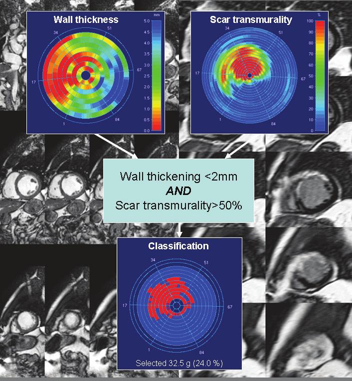 38 Chapter 2 Figure 2-16. Data fusion between wall thickening information derived from cine MR and a scar transmurality derived from LGE MRI visualized using a bulls-eye displays.