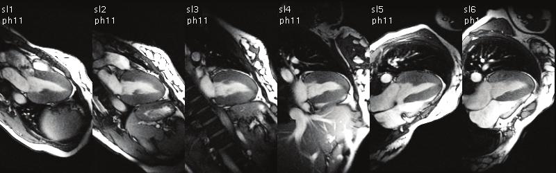16 Chapter 2 Figure 2-4. ED (top) and ES (middle) MR images acquired in radial long-axis views using SSFP MRI. Note the excellent conspicuity of the LV myocardial wall from base to apex.