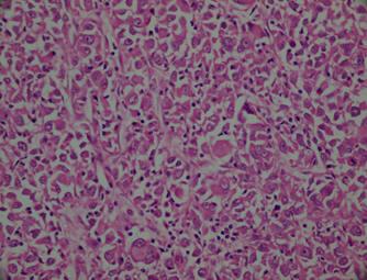 Figure 4 Note the pleomorphic tumor cells and the atypical mitotic figures (H&E,x400).