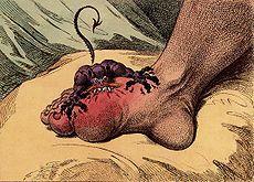 Common sites 1 st MTPj/knees synovitis, erosions, DC sign Dorsum of foot -