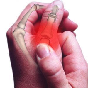 Introducing arthritis Acute or chronic inflammation of one or more joints, usually accompanied by pain and stiffness,