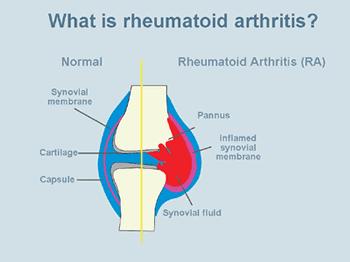 Rheumatoid Arthritis Chronic, progressive autoimmune disease affecting around 600,000 people in the UK Commonly starts between the ages of 40 and 60 Three times more women are affected than men.