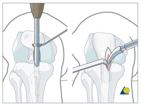 Bone-implant complex (BIC) Nail implantation www.aofoundation.