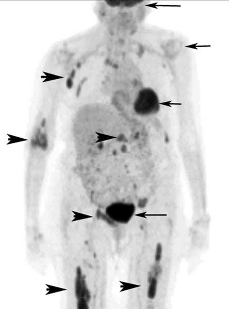 441 Current Status of PET Scan Staging of Lymphoma Figure 1. Initial staging FDG-PET image.