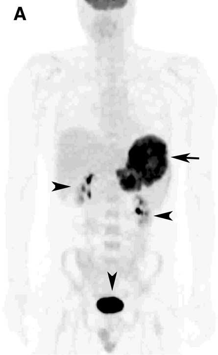 Friedberg, Chengazi 442 Figure 3. Splenic disease and response to chemotherapy.