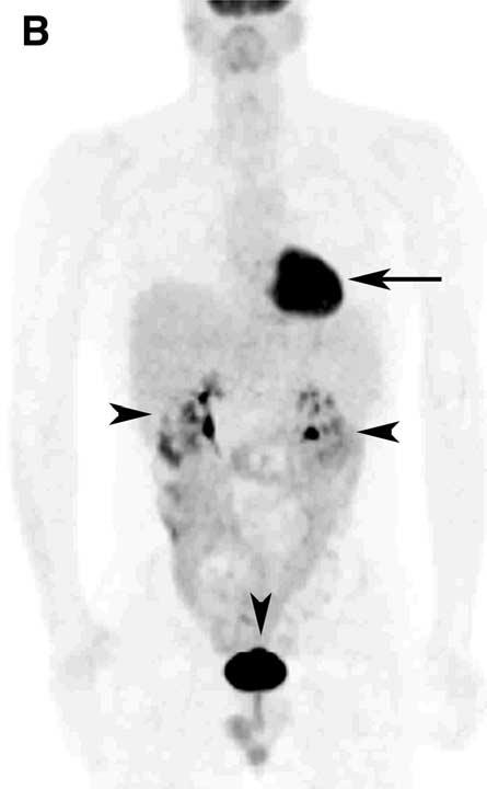 (left arrow), but no other areas of abnormality. Arrowheads point to activity in kidney and bladder.