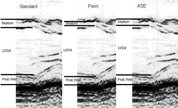 34 Figure 1.1 Echocardiographic Endocardial Definition of Left Ventricular Mass Formulas.