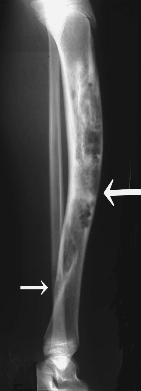 component (Hogendoorn and Hashimoto 2002). It comprises about 0.4% of all primary bone tumors (Huvos 1991).