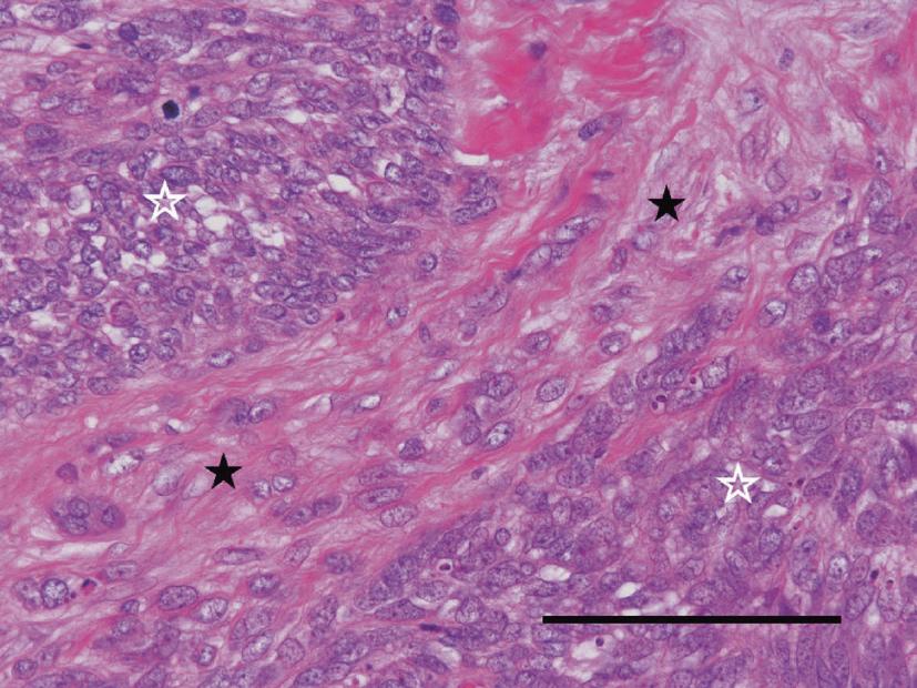 56 M. Hatori et al. Fig. 5. Microphotographs of the biopsy specimen at the age of 23.